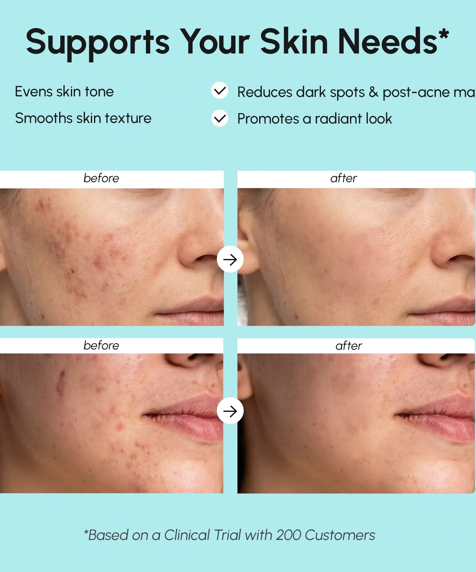 Azelaic Acid Cream for Sensitive Skin